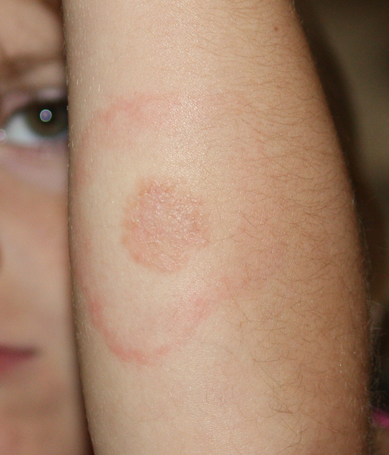 maladie-lyme-enfant-5ans maladie-lyme-enfant-5ans